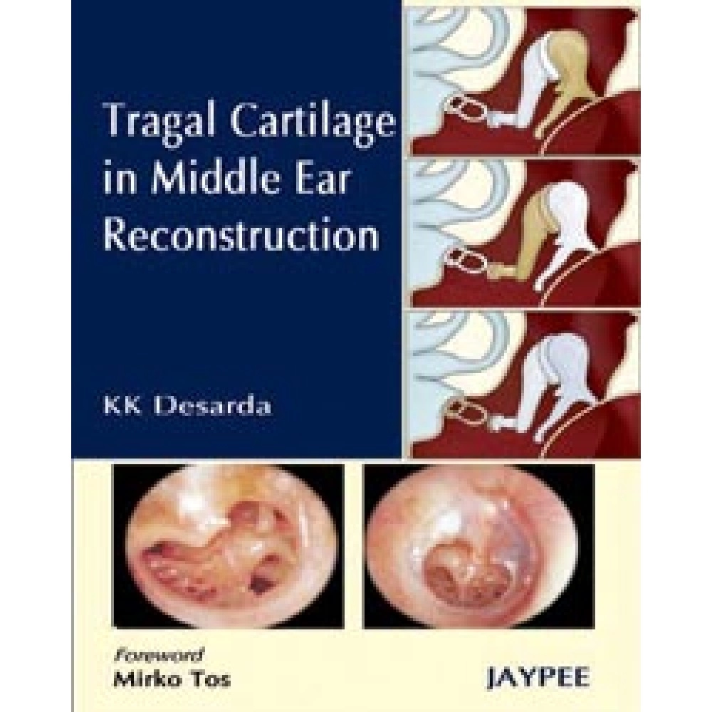 Tragal Cartilage in Middle Ear Reconstruction