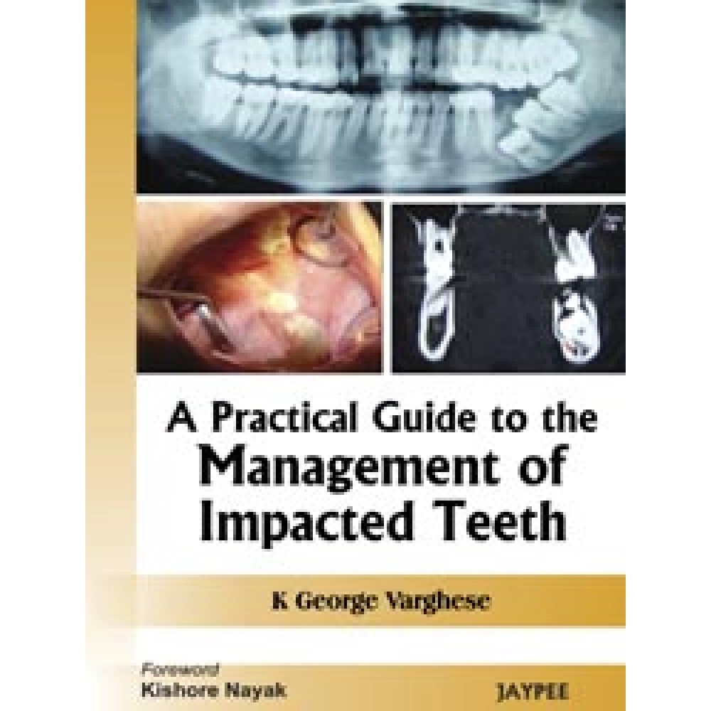 A Practical Guide to the Management of Impacted Teeth