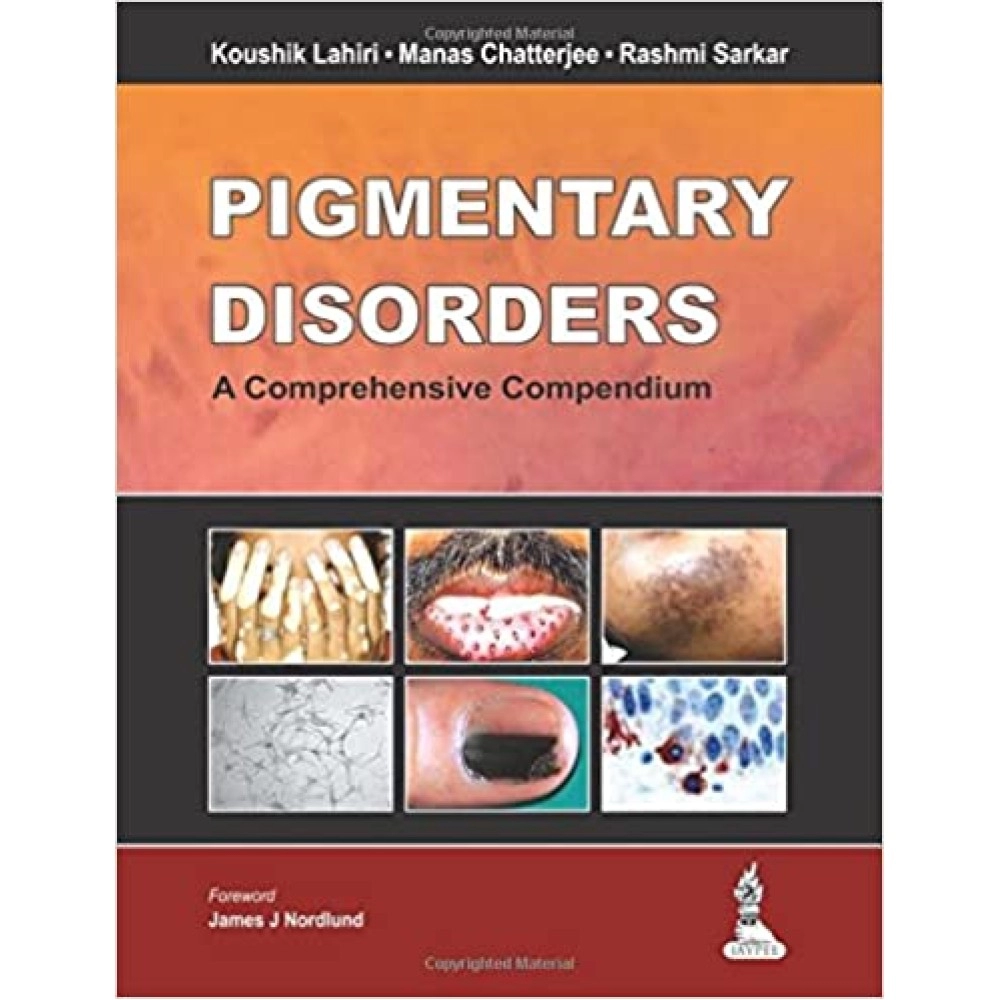 Pigmentary Disorders A Comprehensive Comp