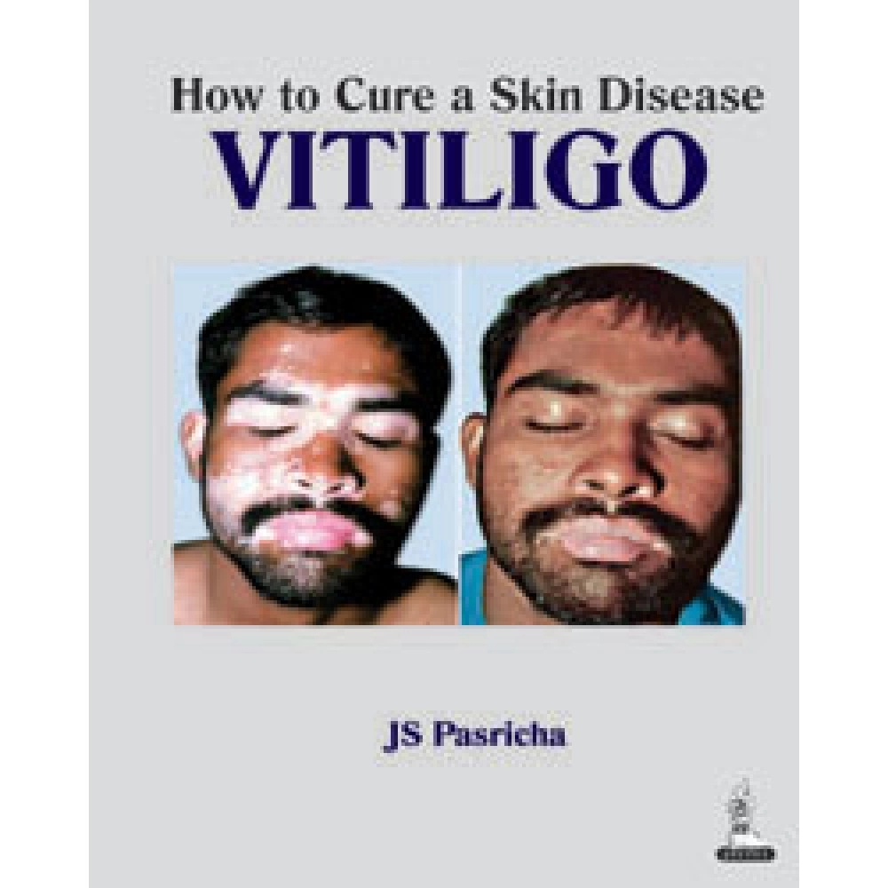How to Cure a Skin Disease Vitiligo