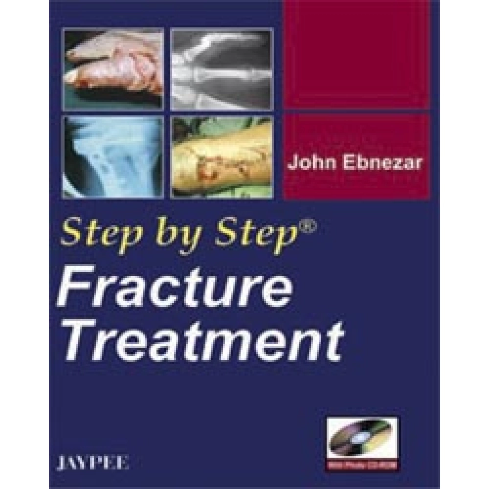 Step by Step Fracture Treatment (with Photo CD-ROM)