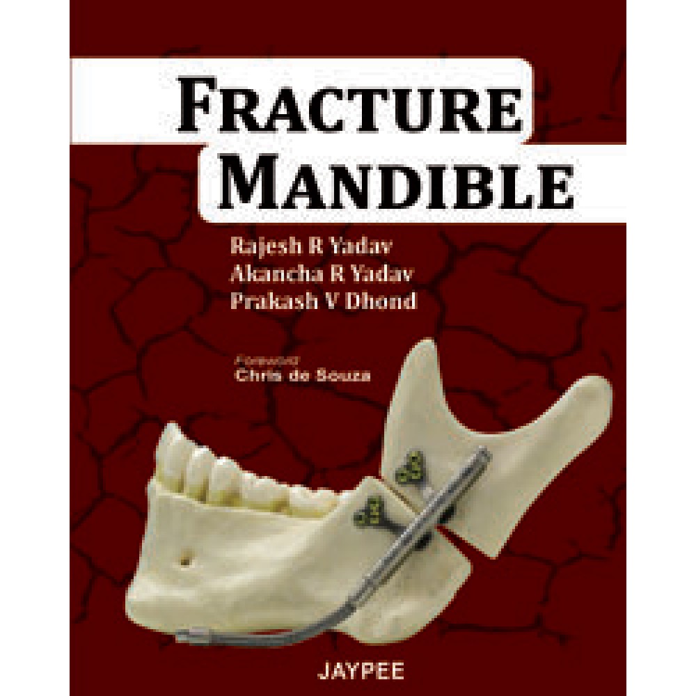 Fracture Mandible