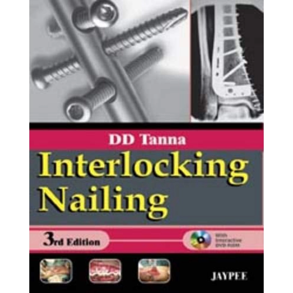 Interlocking Nailing